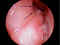 Balloon sinuplasty opens blocked sinus
